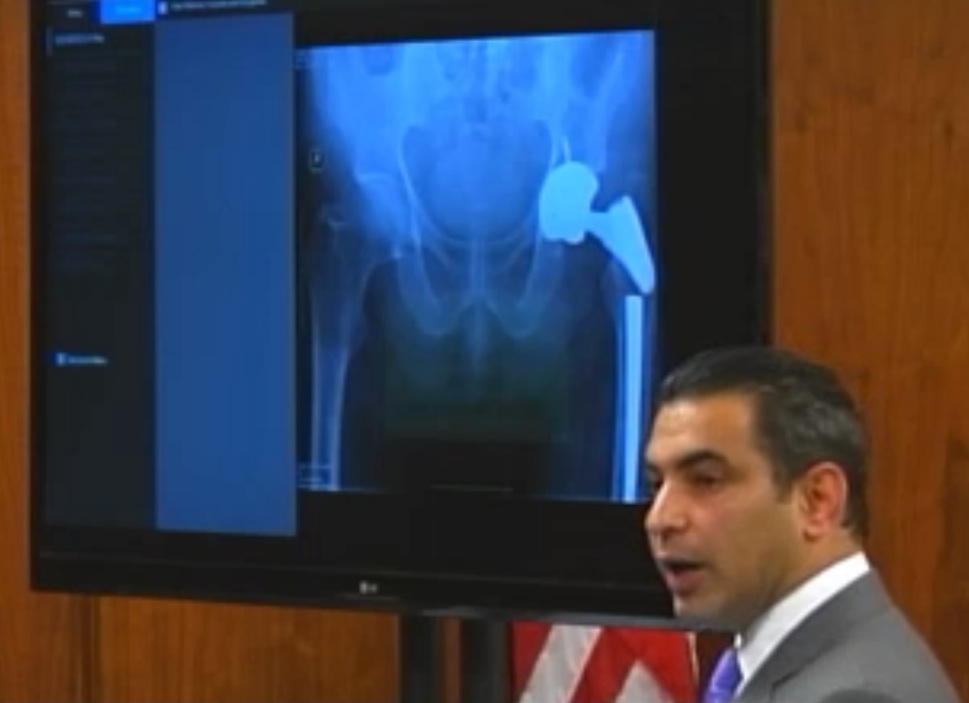 First Wright Hip Implant Product Liability Trial Begins   Warner Openings 